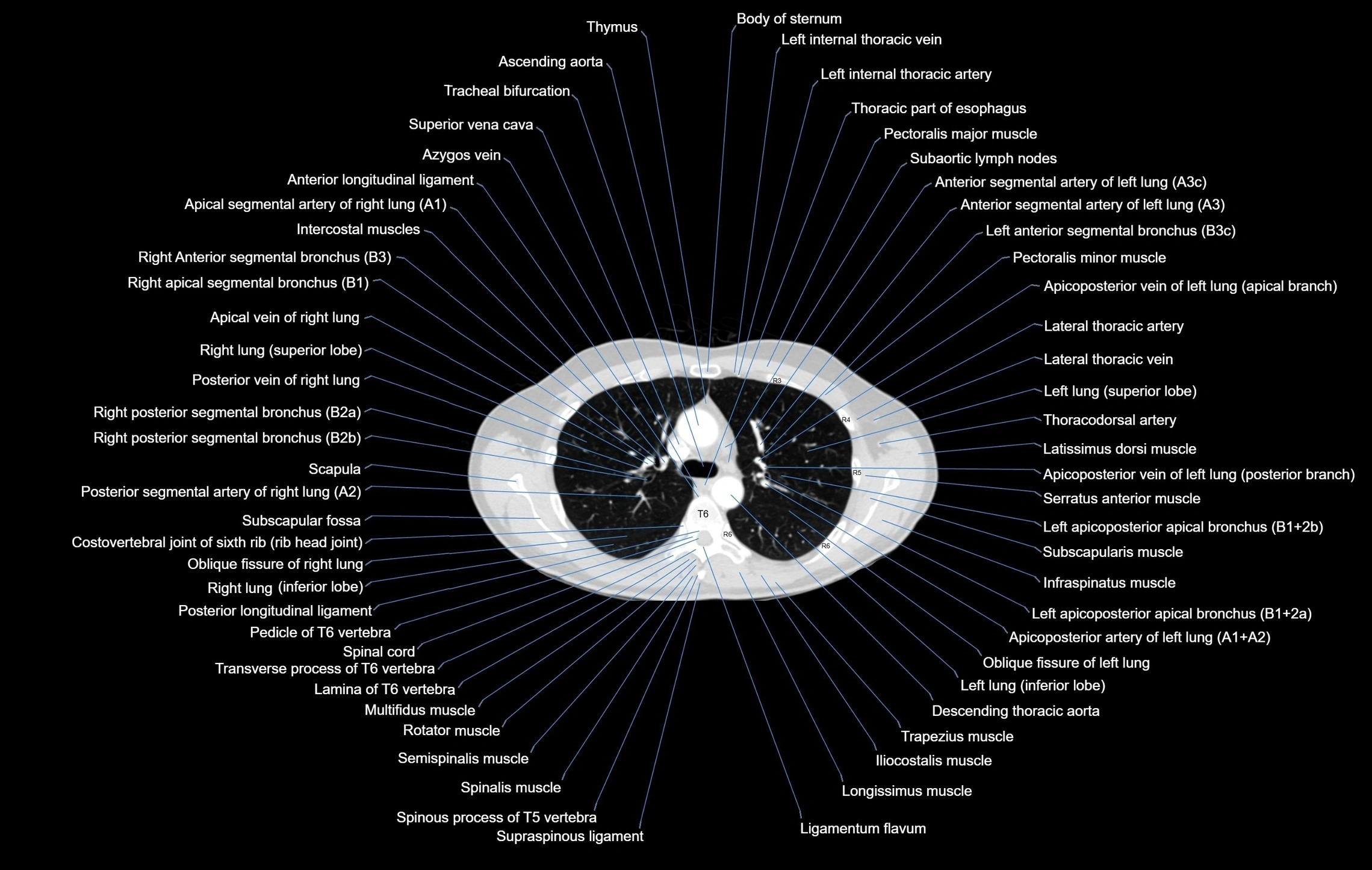 CT chest (thorax) labelled axial cross sectional anatomy radiology image-00045.webp
